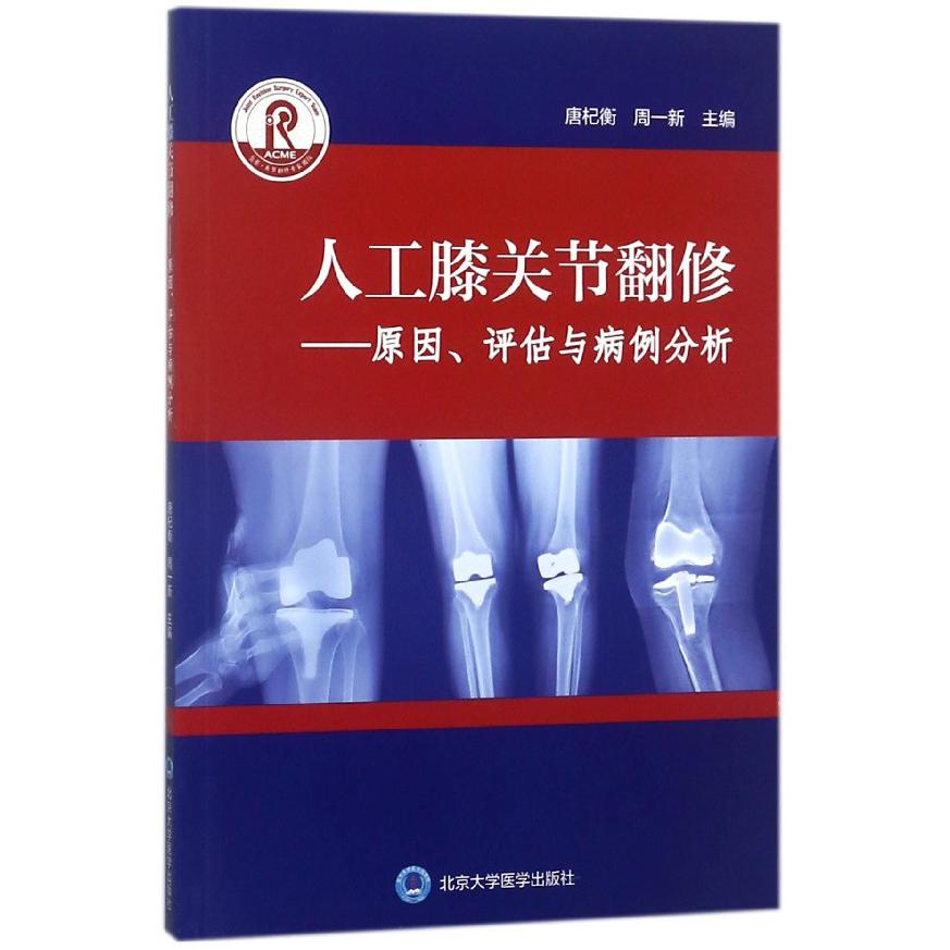 人工膝关节翻修--原因评估与病例分析