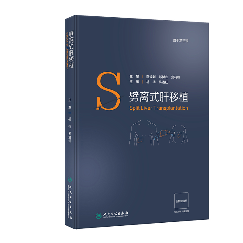 劈离式肝移植