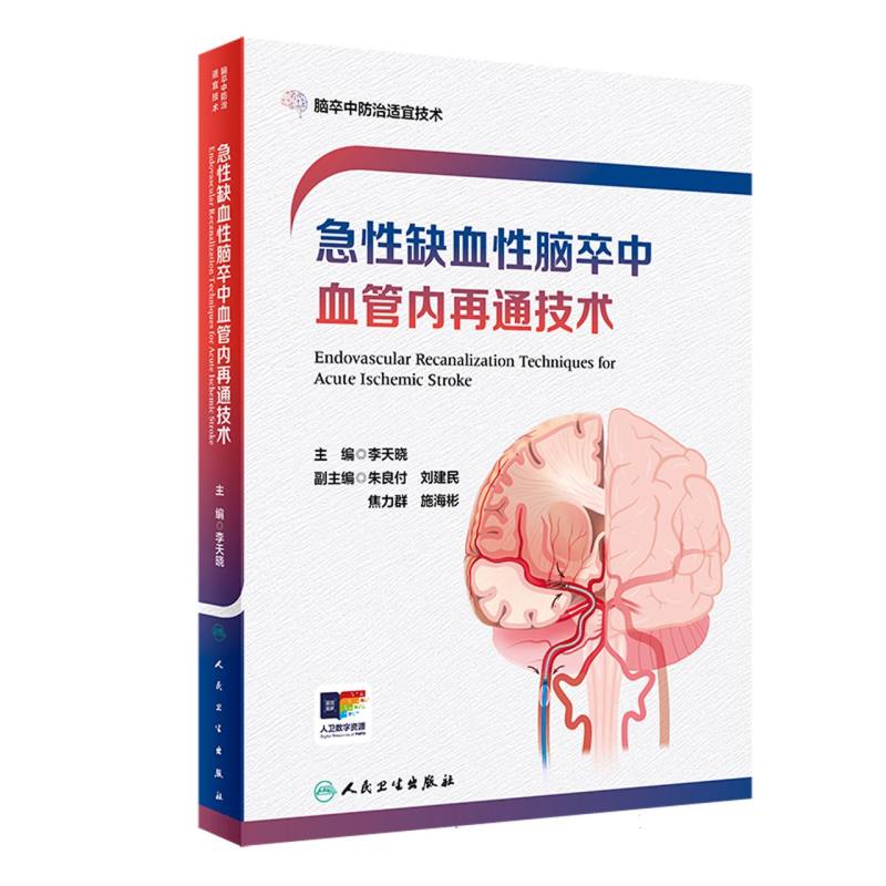 急性缺血性脑卒中血管内再通技术